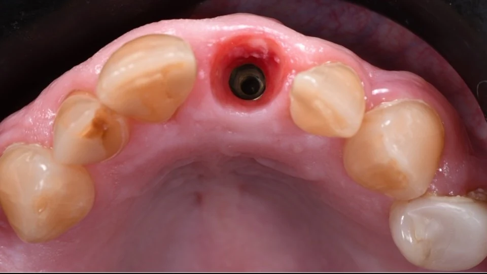 Healed gum contour around the front tooth implant