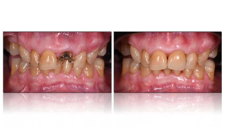 Retracted comparison