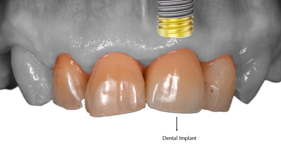 Main case image showing the upper front tooth replacement plan with implant position