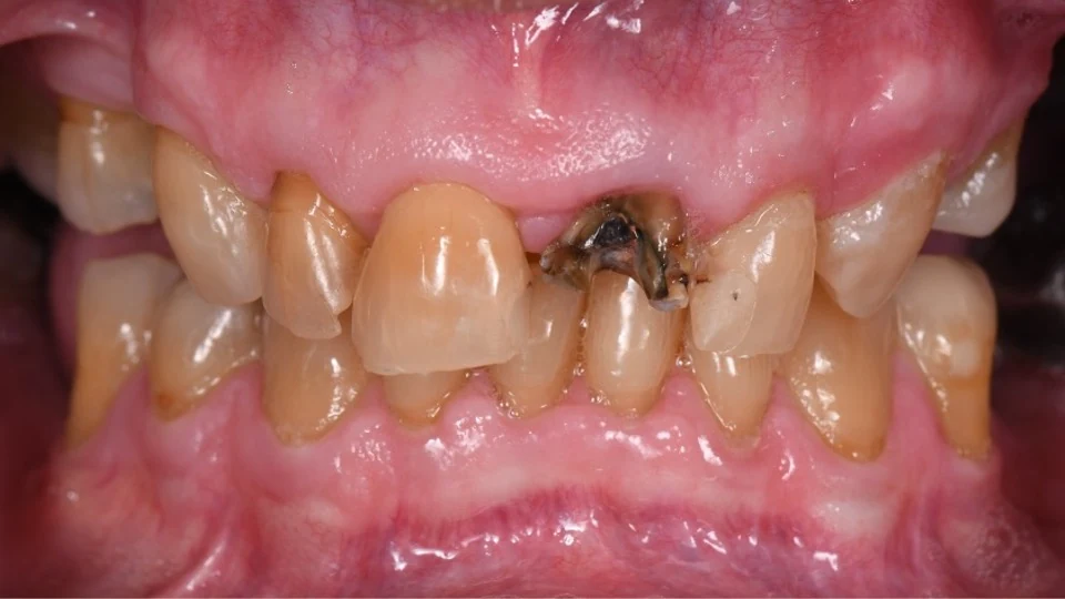 Close-up of severely damaged upper front tooth before treatment