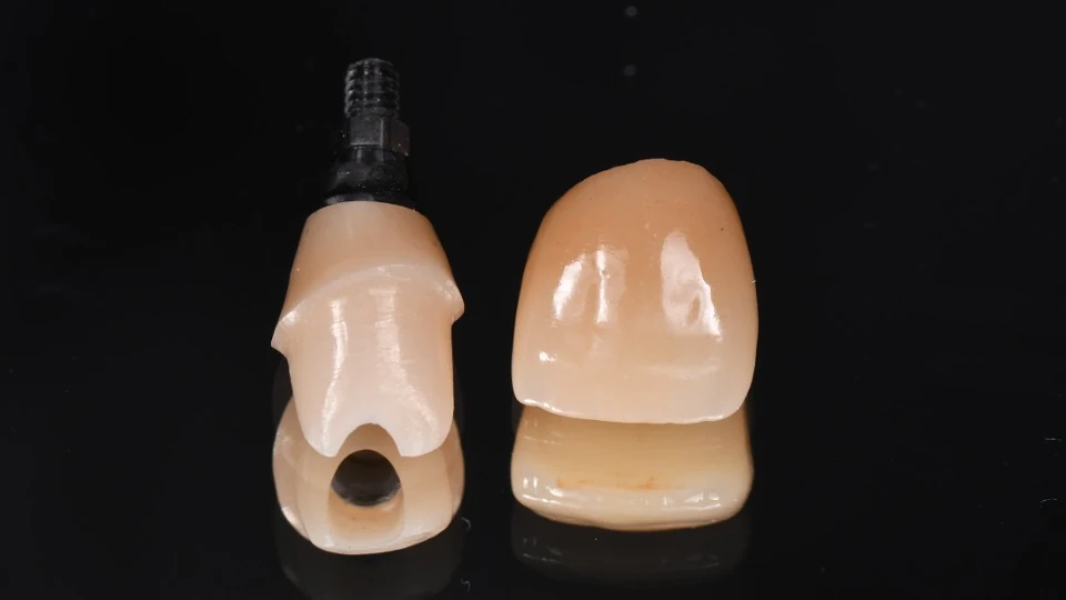 Implant crown and restorative components for the final front tooth restoration