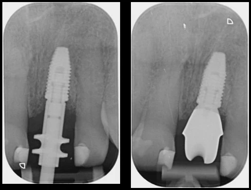 Radiographs of the front tooth implant during treatment and after restoration