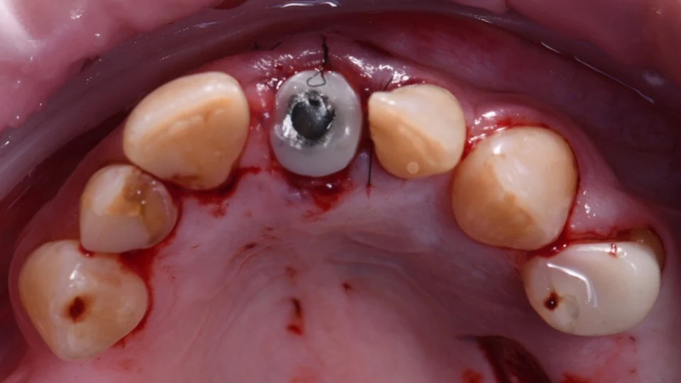 Immediate implant placement after removal of the damaged front tooth
