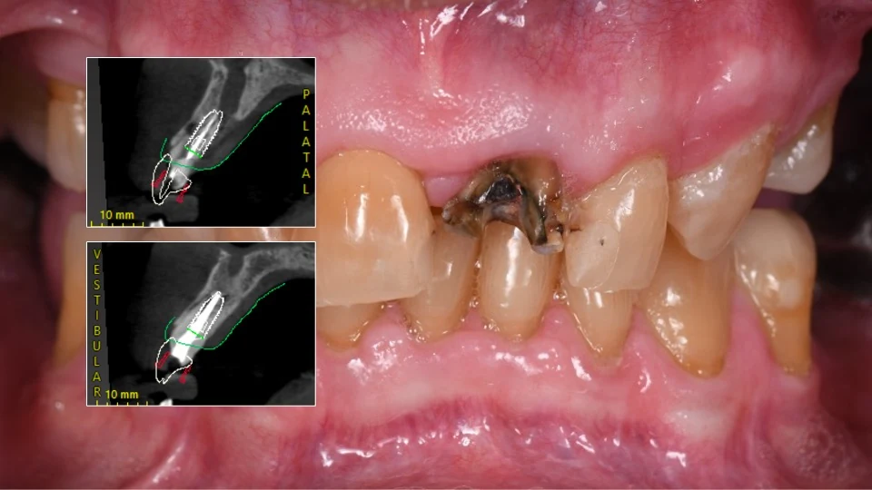 CBCT-based implant planning for replacement of the damaged front tooth