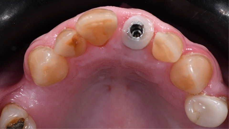 Provisional restoration used during healing after immediate implant placement