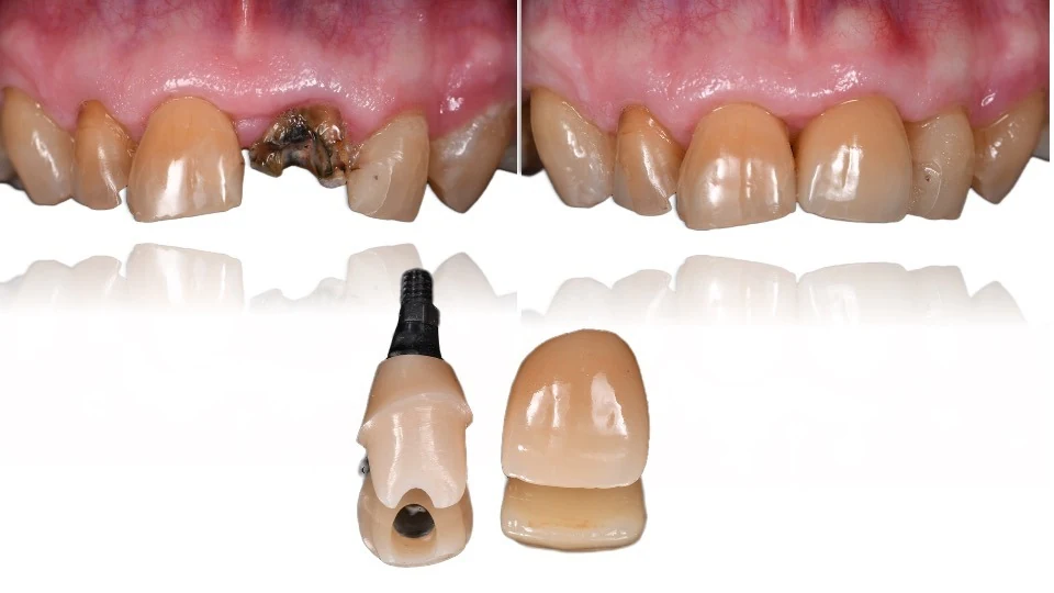 Restoration comparison