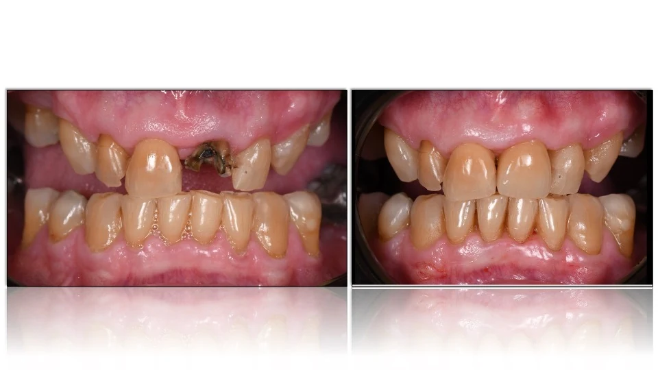 Frontal comparison
