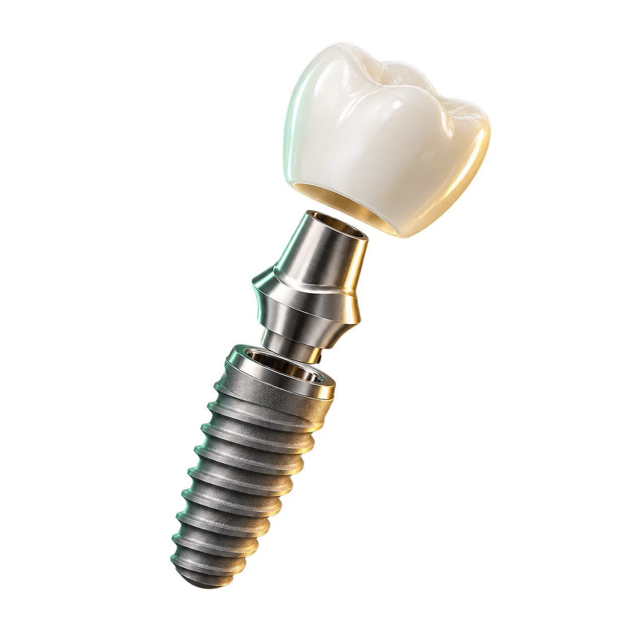 Dental implant restoration