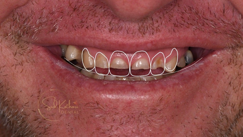 Smile planning with white outlines showing the proposed tooth proportions