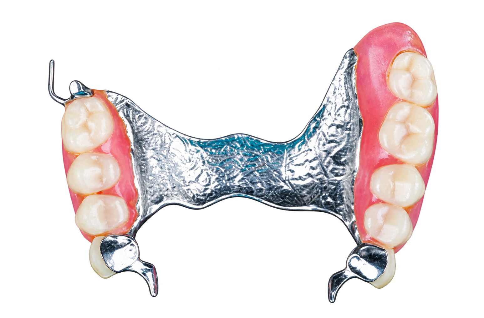 Cobalt-chromium removable partial denture