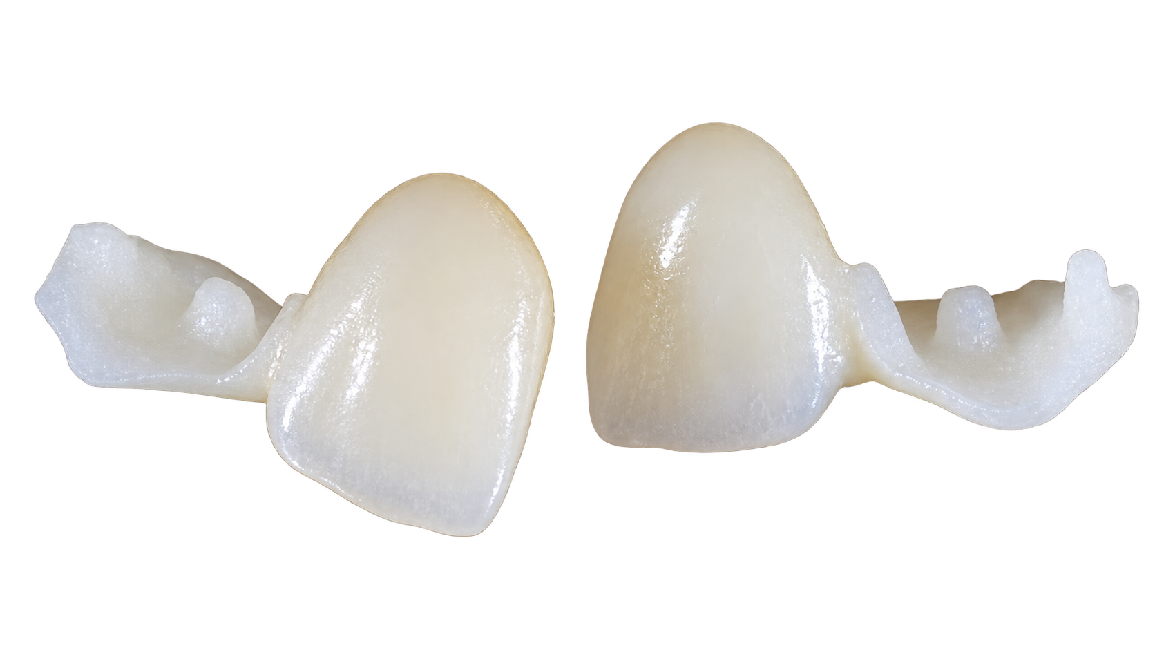 Two ceramic resin-bonded bridges showing their supporting wings