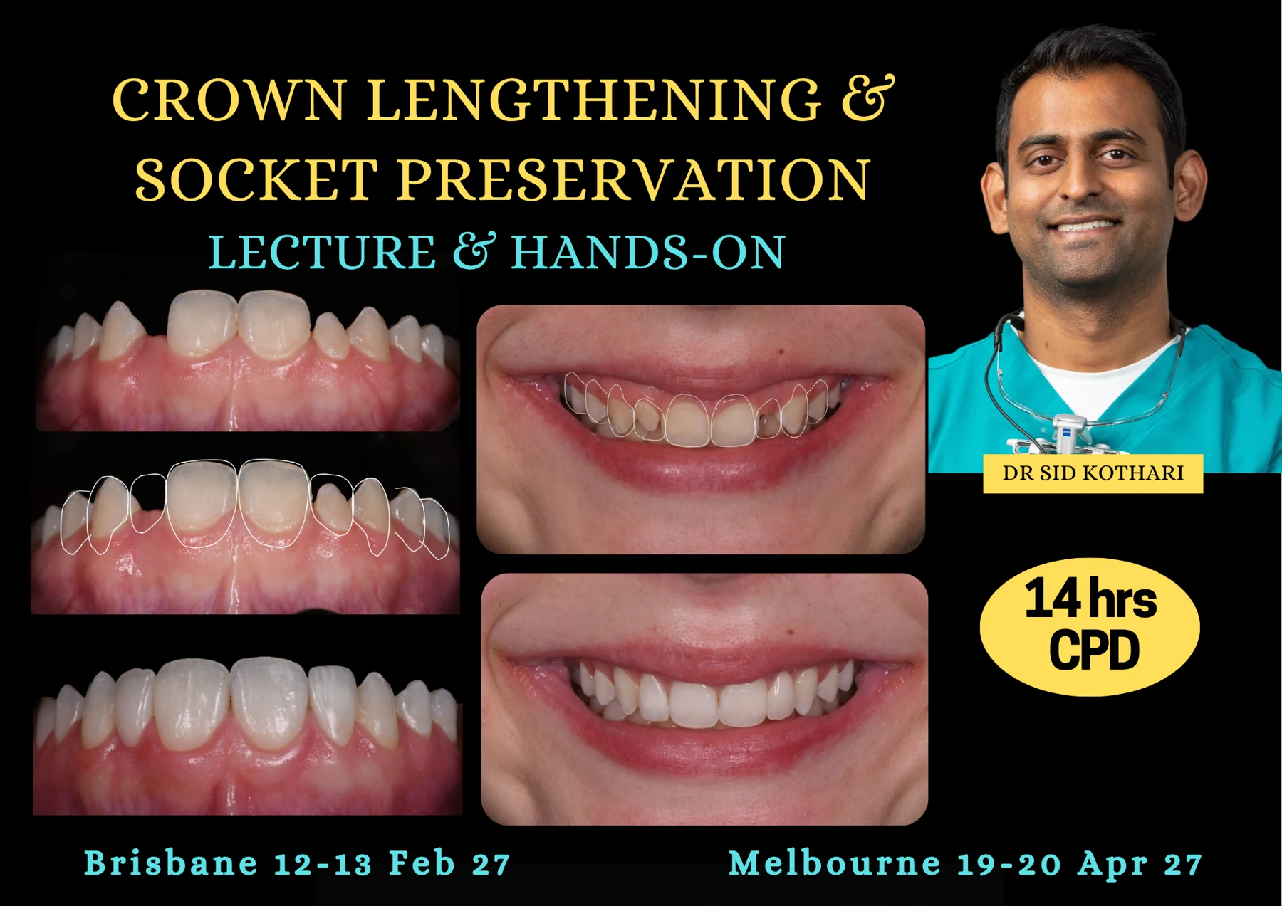 First page of the Crown Lengthening and Socket Preservation course poster